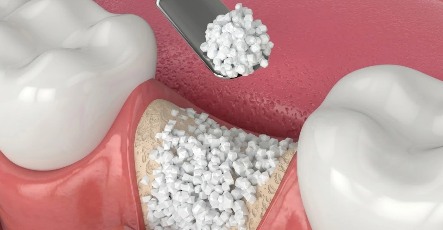 Bone Graft for Dental Implants Types, Materials, Cost & Healing Inblog